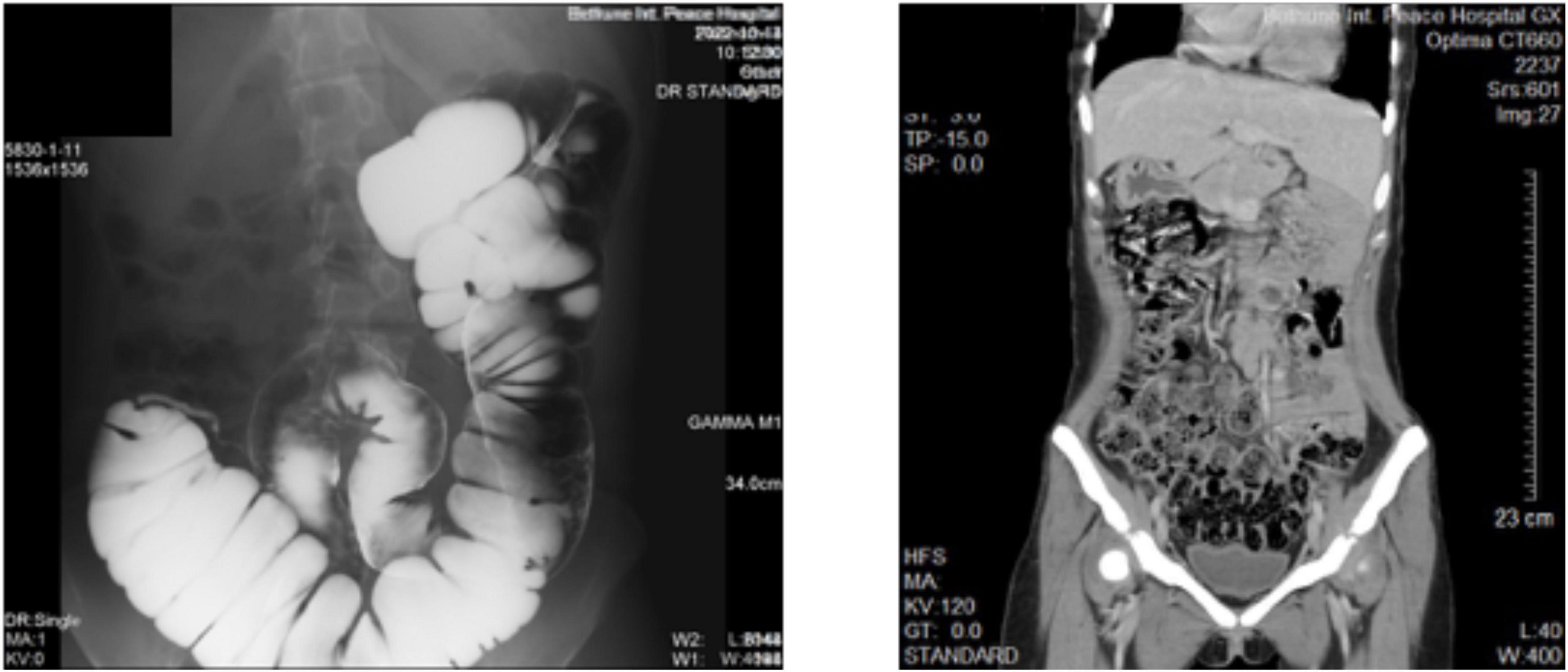 An adult female patient with single atrium and single ventricle undergoing appendectomy: A case report